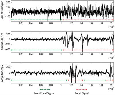 Automatic Change Detection for Real-Time Monitoring of EEG Signals